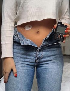 Moas mage med insulinpump i handen. Magtröja och uppknäppta byxor